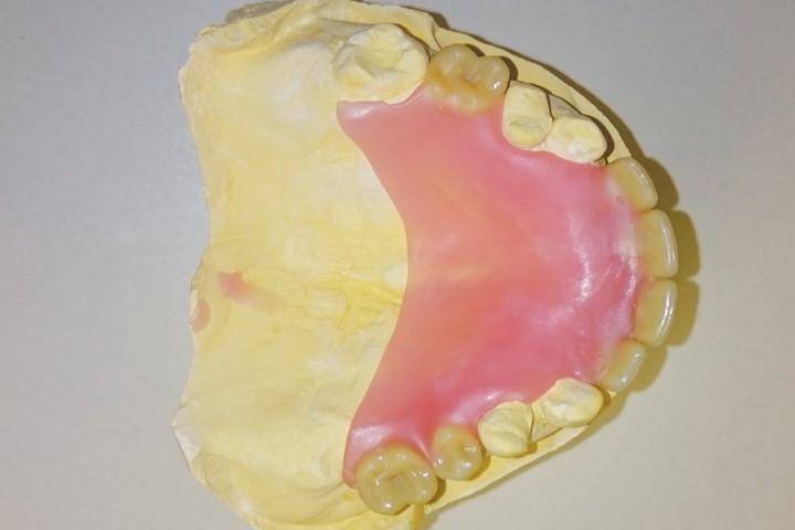Young Dentures Before And After Mulberry IN 46058